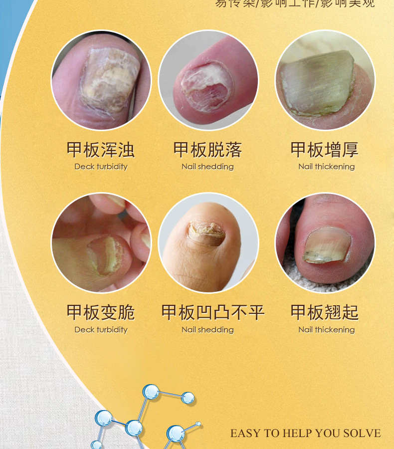 湘桐新亮甲美甲液增厚亮甲灰甲净软甲膏 灰指甲液 现货批发