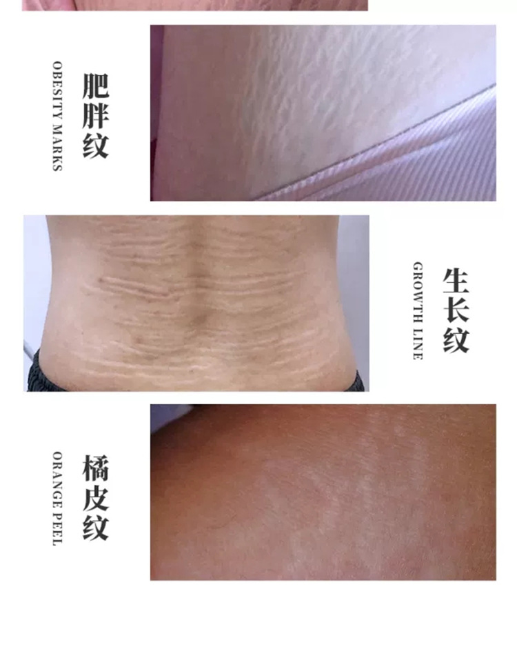 coscia妊娠纹修护霜产前精华油产后修复霜孕妇生长纹肥胖纹100g