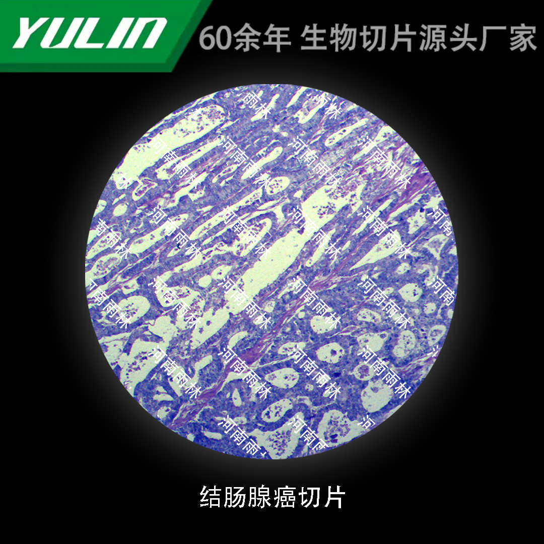 结肠腺癌切片生物显微镜标本动物植物细胞载玻片观察实验高校