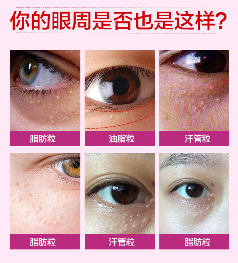 诗莱格去脂肪粒草本精华液去脂肪粒油脂粒汗管粒眼部修复霜 可oem