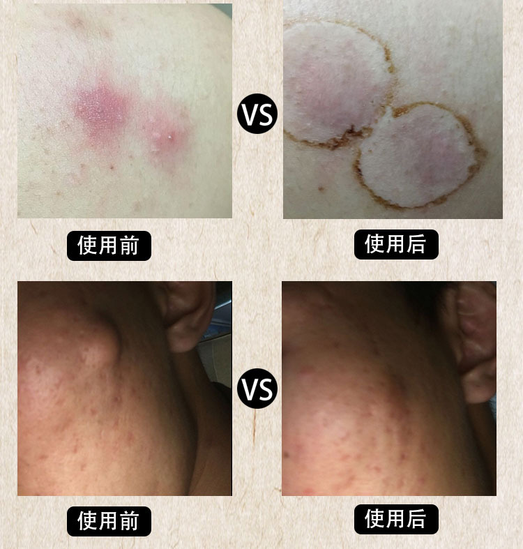 拔毒膏拔脓贴 火疖子坐板疮 拔脓膏 买2份送1份 咨询客服对症购买