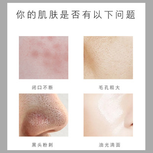 Oem Processing Deep Cleansing Blackhead Export Gentle and Fine Pore Blackhead Export Liquid Factory Oem Oem