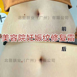 Stretch Marks Removal Postpartum Repair Cream Fades Obesity Marks Growth Marks Orange Peel Marks Removal Pregnancy Marks Scar Mummy Tightening Cream