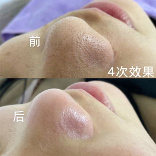 Hair Follicle Cleaning Cream, Beauty Salon Specially Designed to Remove Blackheads and Shrink Pores, Deep Purification Cream, Hospital Facial Massage Cream