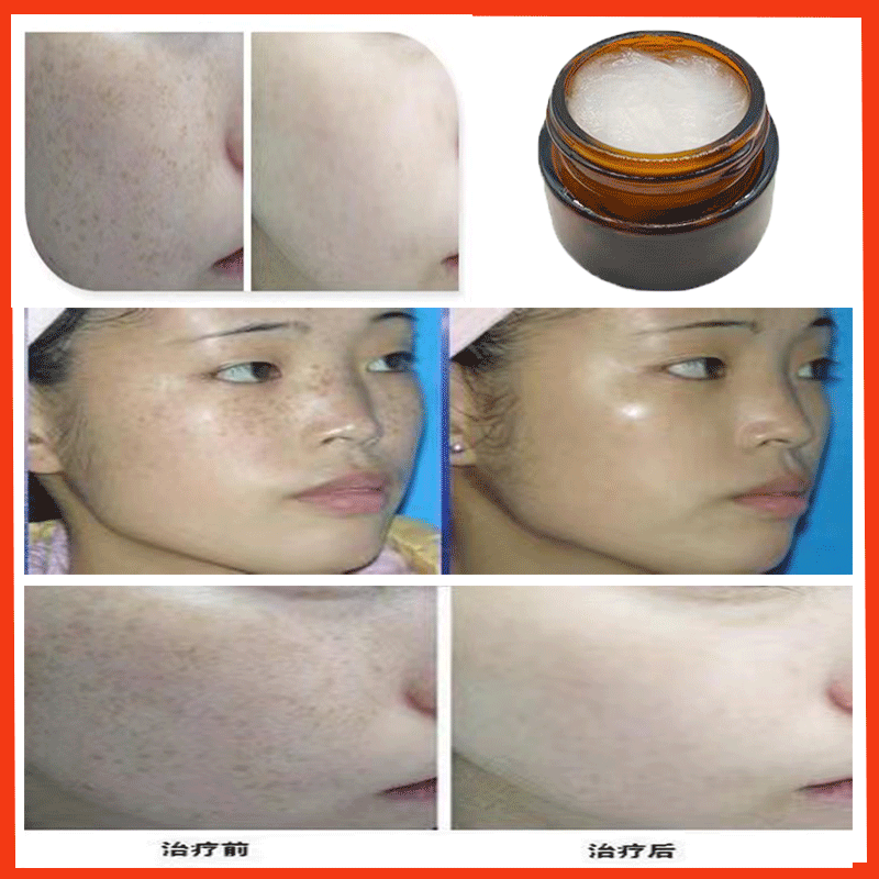 Anti-scab Growth Peptide Cream to De-spot Dot Nevus Zero-scab Prevention of Pigment Backflow Repair Rapid Meat Growth