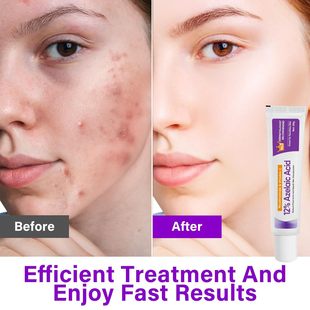 Трансграничное Специально для 12% Azelaic Acid азелаиновая сыворотка для осветления прыщей