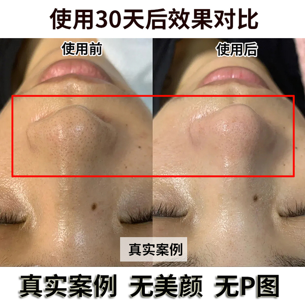 韩纪茶树去黑头套盒官方正品收毛孔深层清洁院线大牌专用XZA68 — 2
