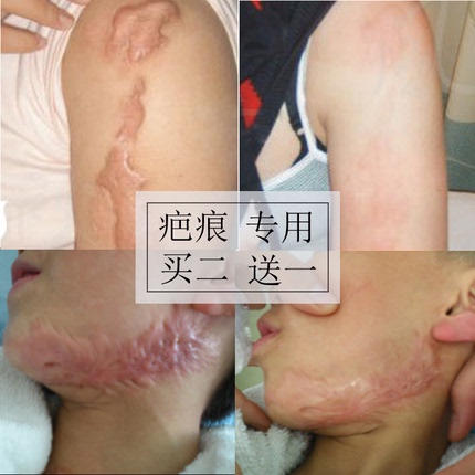 淡疤痕陈旧性祛老疤痕修复膏烧烫疙瘩凸起液刀疤手术增生脸部去除
