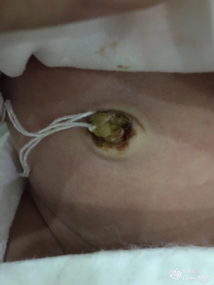 결찰 라인 밸브 코어 2개 팩 일회용 제대 결찰 라인 제대 결찰 라인