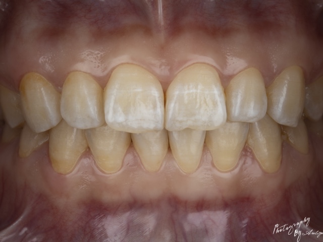 페인트 라이트 다빈치 확산 마스크|치과 사진용 이중 플래시 소프트 마스크|HG 소규모 스튜디오