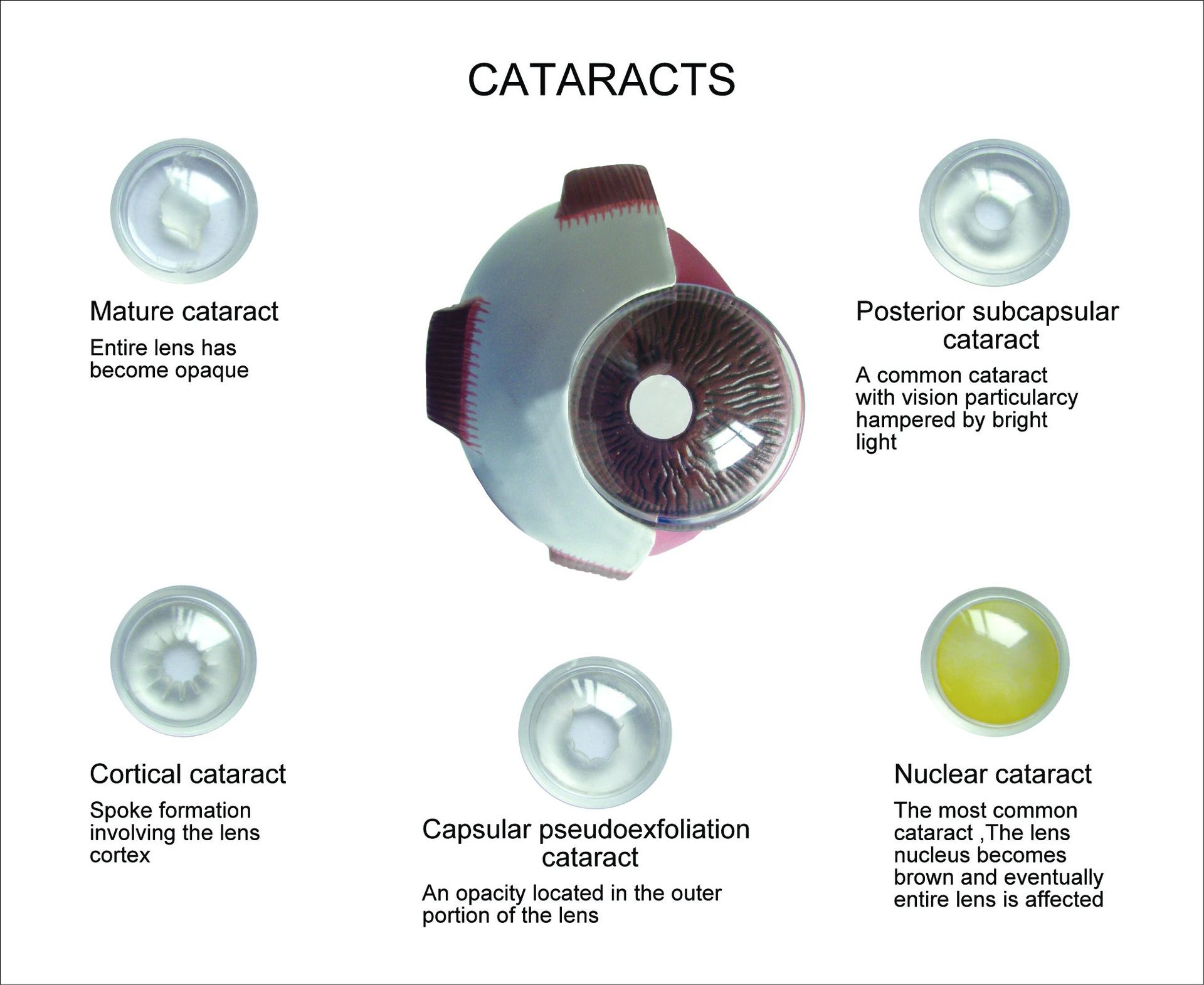 白内障模型的背板