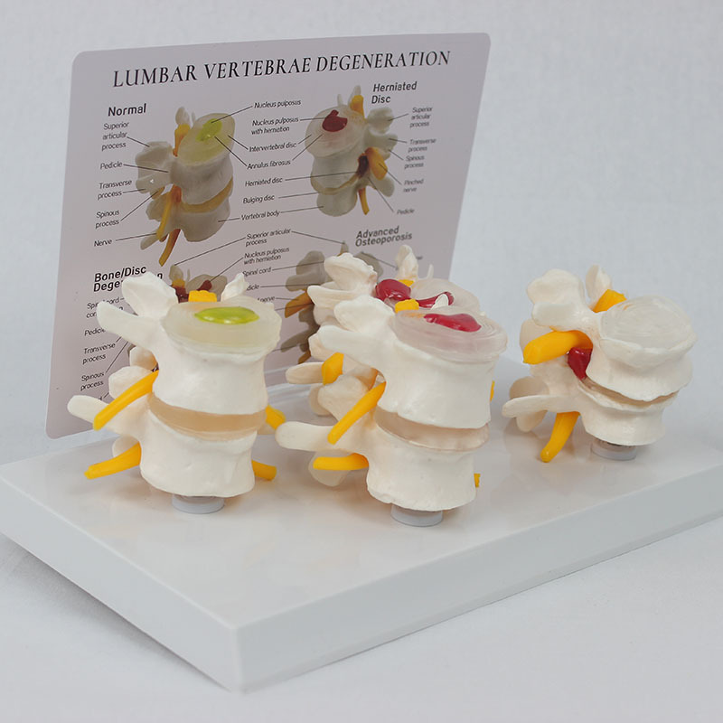 4阶段病变腰椎带背卡3