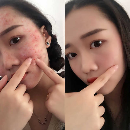 herbal brightening acne cream from black spots for men and women