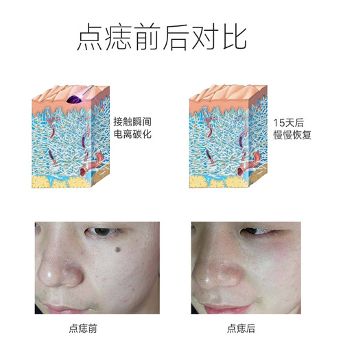 Spot scanning German novice does freckle removal, spot pen, mole removal laser, beauty instrument, special hemorrhoid spotting pen