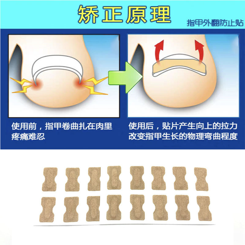 源头工厂免胶水嵌甲矫正贴 脚指甲正甲贴嵌甲矫正器贴片 矫正指甲