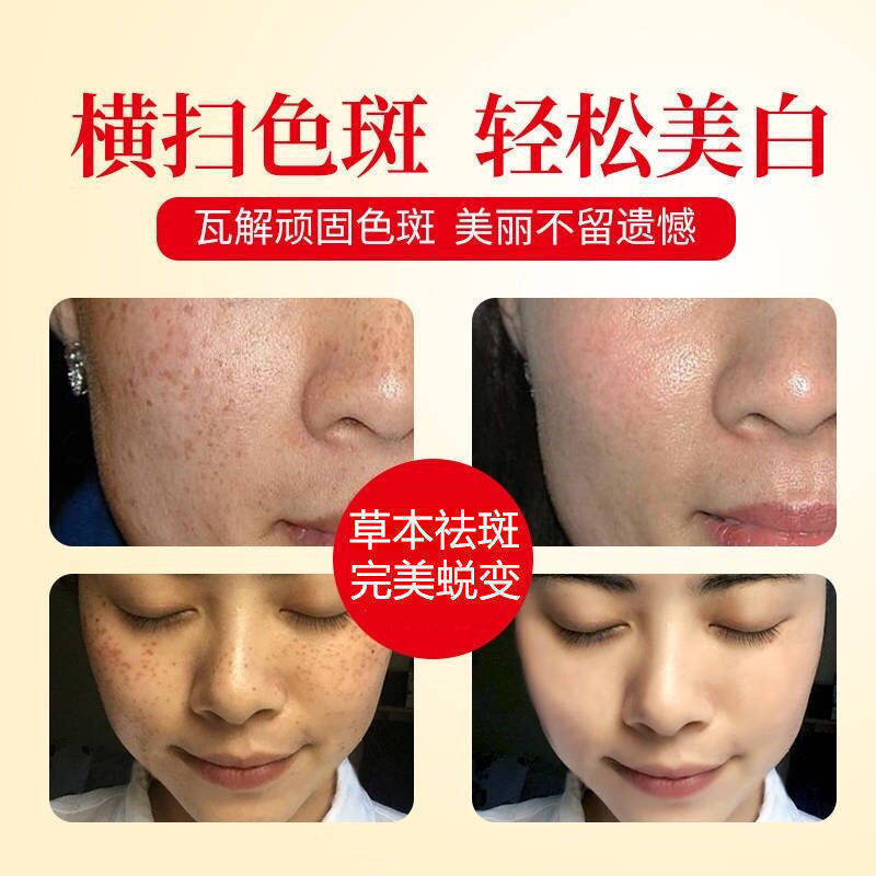 New arbutin freckle removing liquid decomposition melanin whitening spot solution light licorice freckle removing essence agent hair