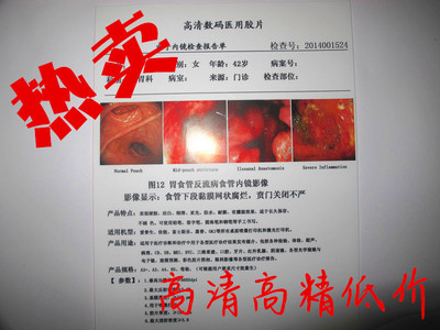 A4亞光雙面打印PET醫用噴墨激光打印膠片 B超四維彩超胃腸鏡PET