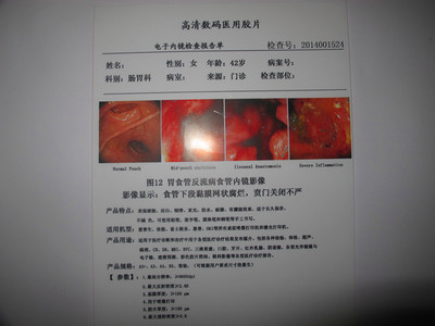 Two-sided B5 White porcelain medical Jet laser Printing film B- Siwei Ultrasound Gastrointestinal endoscope film  0.175mm