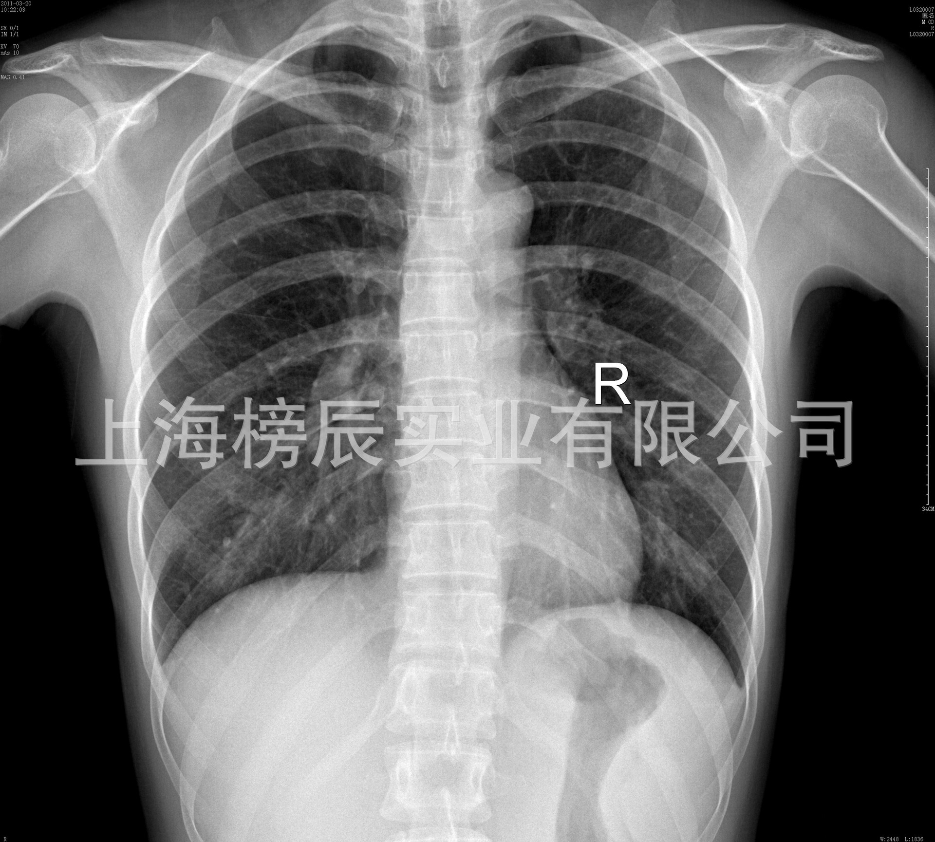 定制医用喷墨蓝片干式放射科DR/CR/CT打印胶片牙科骨折X光片