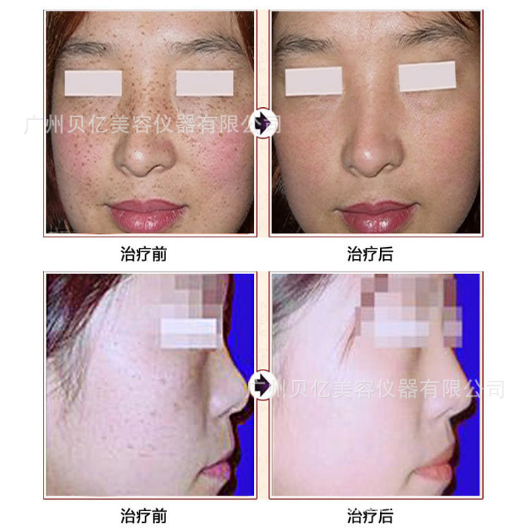 OPT冰點脫毛機 無痛祛斑嫩膚機 IPL光子祛痘 E光升級版OPT美容機