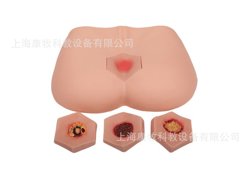 阶段褥疮护理模型
