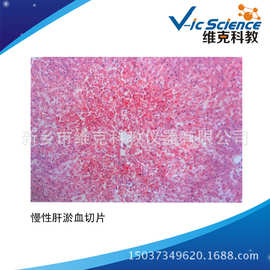 直供 慢性肝 淤血切片 高等学校医学图片 血液循环障碍 生物切片
