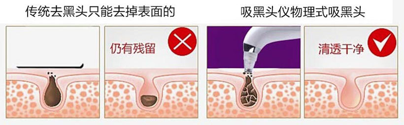 黑頭機方法