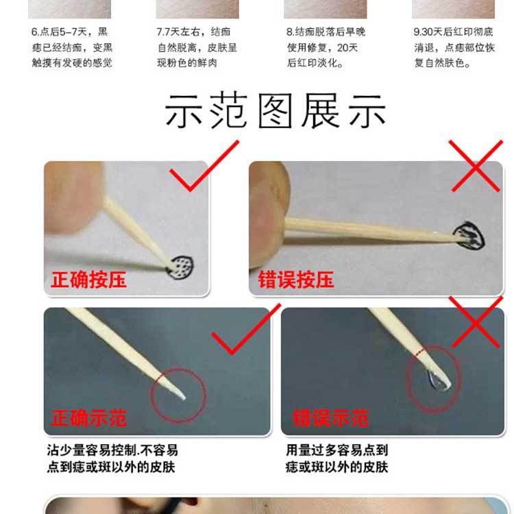 點斑水 七天不留痕無痛點斑點痣水 點斑祛斑水可點雀斑 疣 點斑液