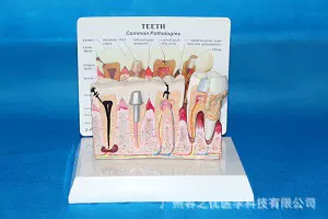 人体牙齿模型 桌上型病牙表现带说明板 教学模型