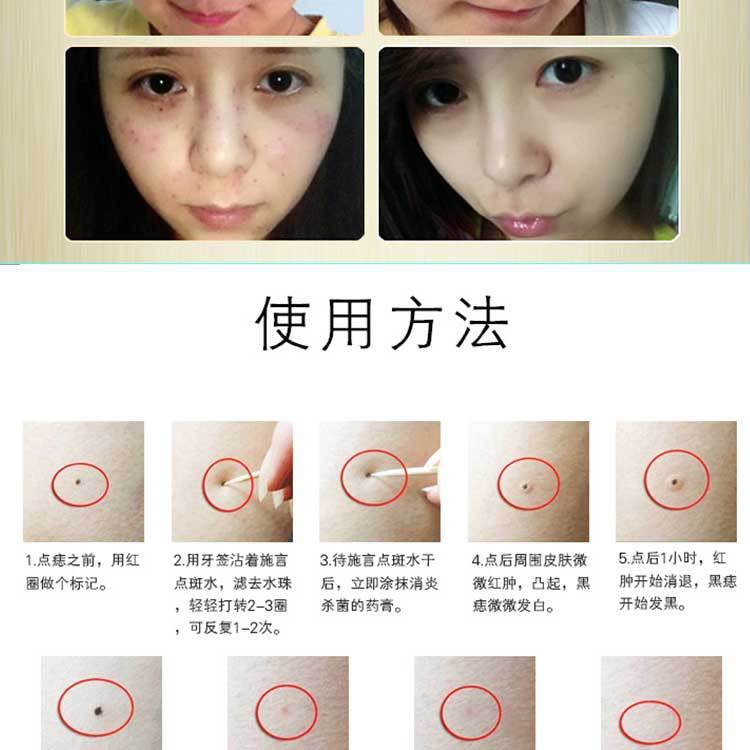 點斑水 七天不留痕無痛點斑點痣水 點斑祛斑水可點雀斑 疣 點斑液