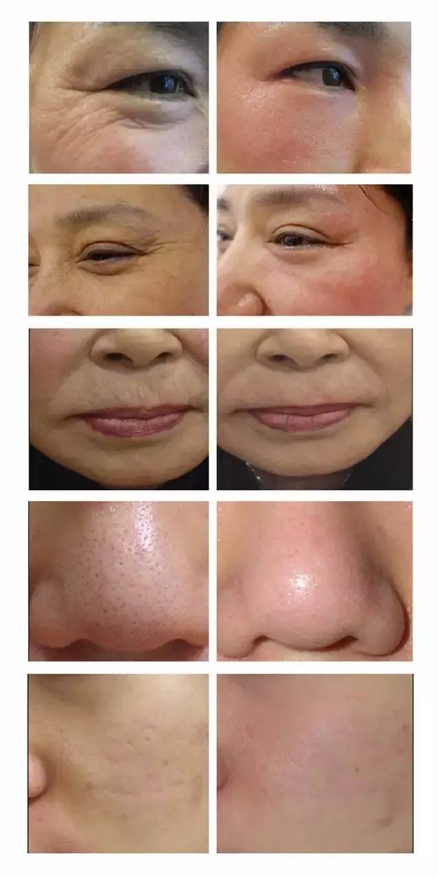 1550神光祛皱王 抗衰祛皱祛妊娠纹 光纤皮秒1550