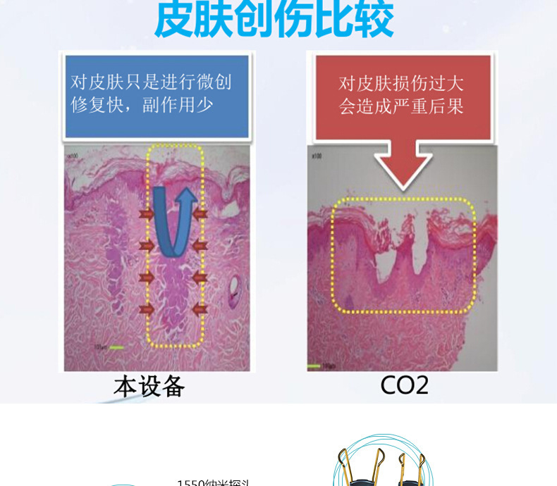 1550神光祛皱王 抗衰祛皱祛妊娠纹 光纤皮秒1550