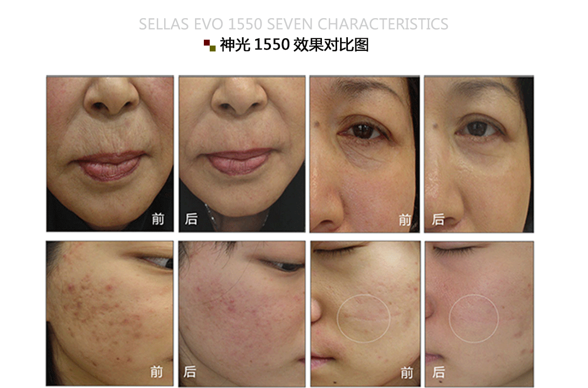 1550神光祛皱王 抗衰祛皱祛妊娠纹 光纤皮秒1550