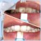 跨境貨源新款SH005(1+4)潔牙擦 口腔清潔Teeth cleaning kit