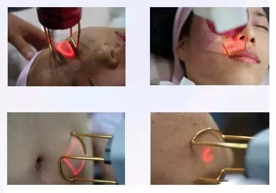 1550神光祛皱王 抗衰祛皱祛妊娠纹 光纤皮秒1550