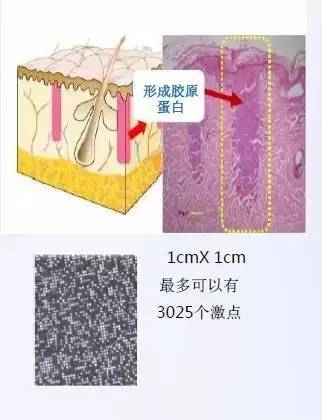 1550神光祛皱王 抗衰祛皱祛妊娠纹 光纤皮秒1550