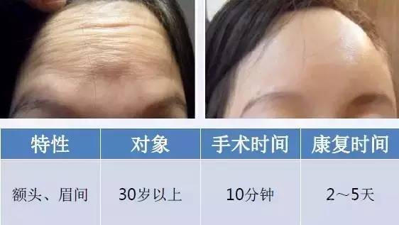 1550神光祛皱王 抗衰祛皱祛妊娠纹 光纤皮秒1550