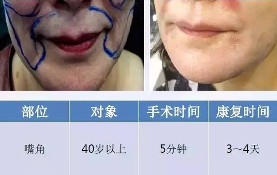 1550神光祛皱王 抗衰祛皱祛妊娠纹 光纤皮秒1550