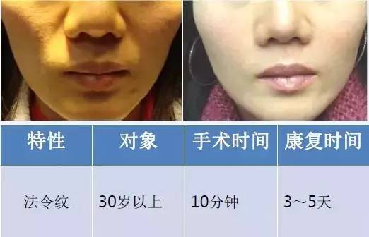 1550神光祛皱王 抗衰祛皱祛妊娠纹 光纤皮秒1550