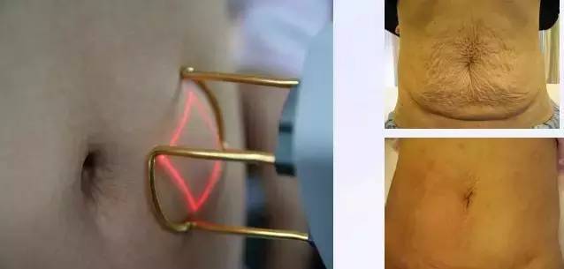 1550神光祛皱王 抗衰祛皱祛妊娠纹 光纤皮秒1550