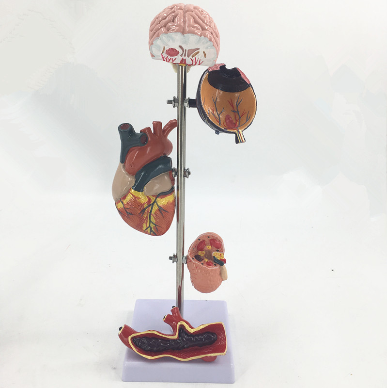 High Blood Pressure Model
