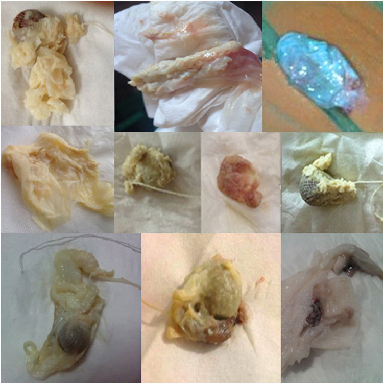 金勝美婦科排丸毒清宮丸産後陰道白帶異常私處拉線丸護理護陰丹