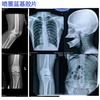 医用喷墨打印蓝基放射胶片DR CR CT X光MR磁共振喷墨蓝片彩色成像