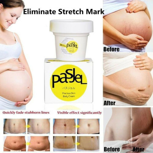 alpha arbutin stretch marks