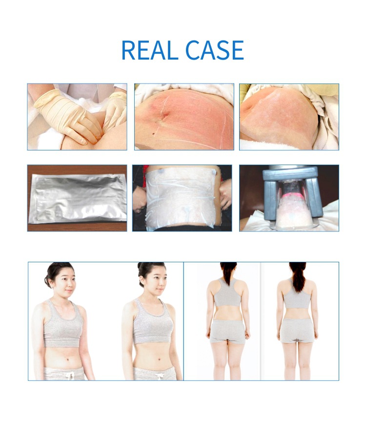 冷冻溶脂仪 Cryolipolysis+40K