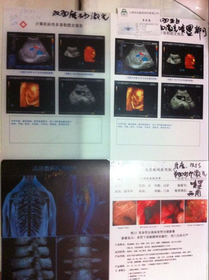 A4 Матовая Белая двусторонняя печать B ультразвуковая КТ/ДР/КР ядерный магнитный резонанс медицинский лист струйный лазер 0,15 мм
