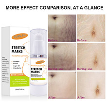 羳SNMLPM Stretch marks creamw̝Ħ˪stretch mark