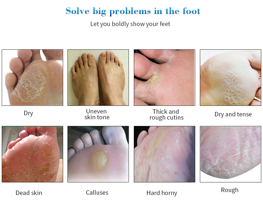 EFERO Foot Mask Application