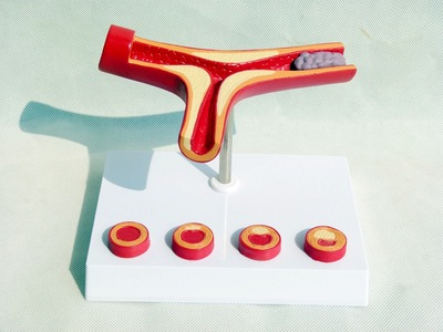 人体支脉粥样11硬化 心血管动脉1解剖模型 血栓 模型人体血管模型