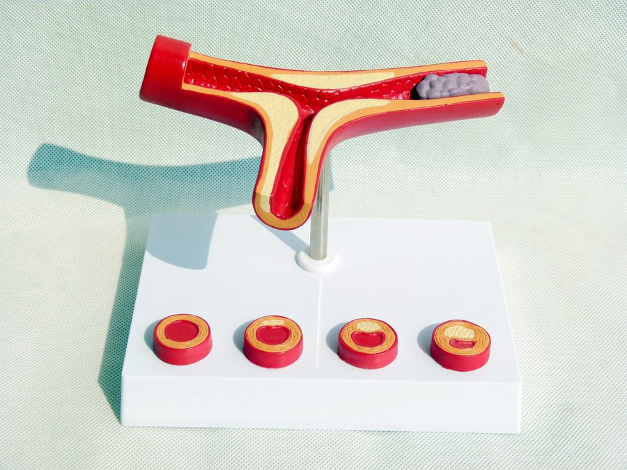 人体支脉粥样11硬化 心血管动脉1解剖模型 血栓 模型人体血管模型